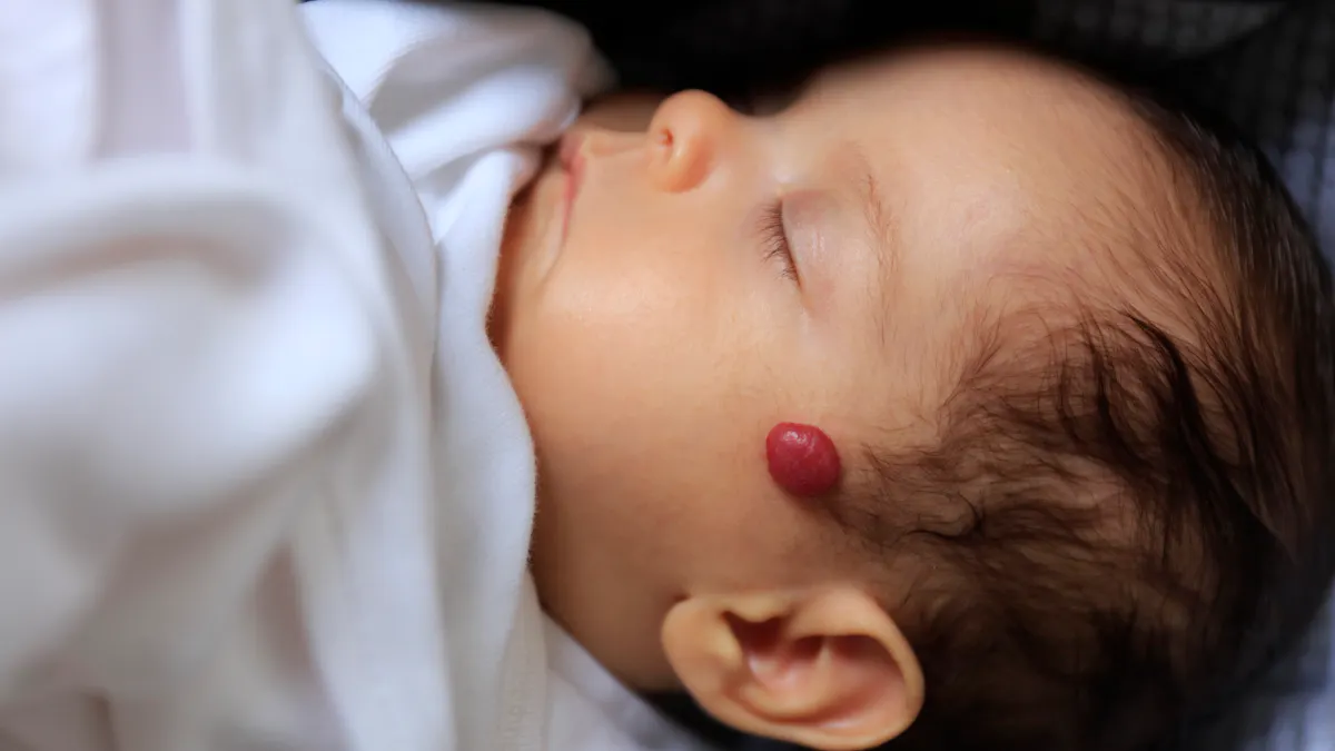 Hemangiome Infantile Le Detecter Le Soigner Et Soulager Bebe Parents Fr Hemangiome Infantile Le Detecter Le Soigner Et Soulager Bebe Parents Fr