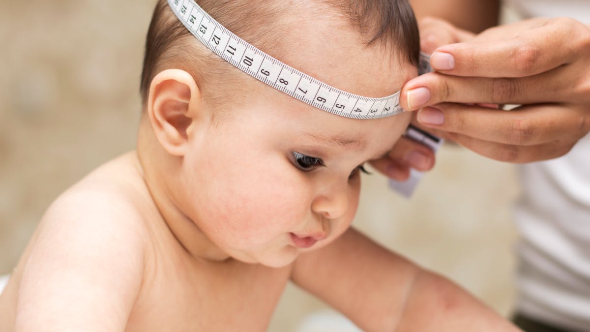 Craniostenose Tout Savoir Pour La Detecter Et Accompagner Bebe Parents Fr Craniostenose Tout Savoir Pour La Detecter Et Accompagner Bebe Parents Fr