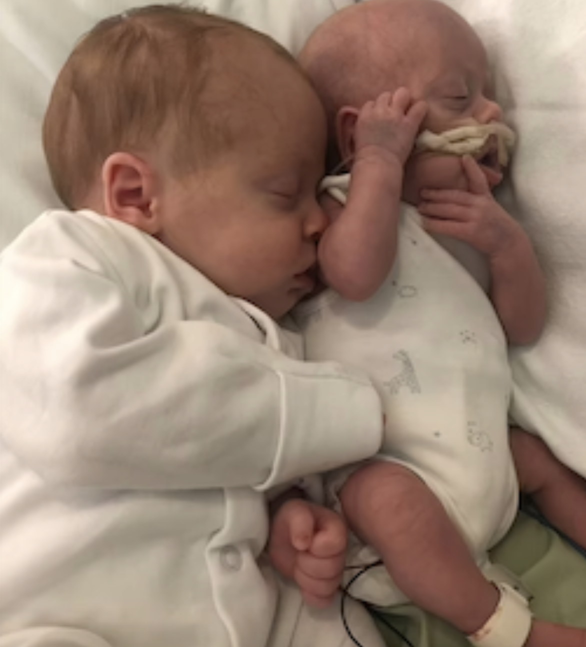 Prématurité : un jumeau né prématurément survit grâce à son frère |  Parents.fr