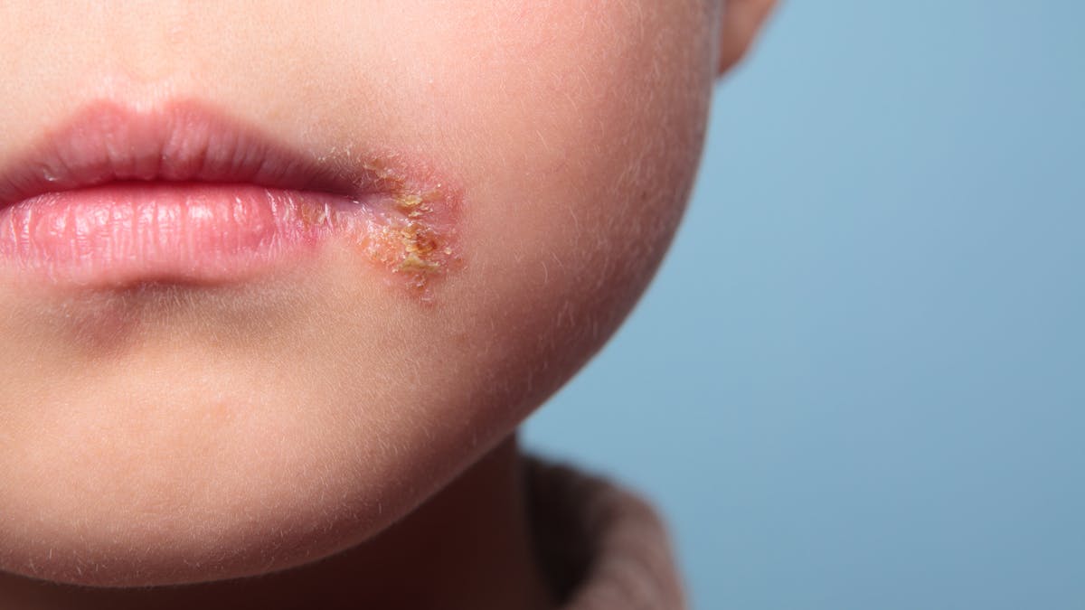 L Herpes Chez Les Enfants Et Les Bebes Symptomes Diagnostic Traitement Parents Fr L Herpes Chez Les Enfants Et Les Bebes Symptomes Diagnostic Traitement Parents Fr