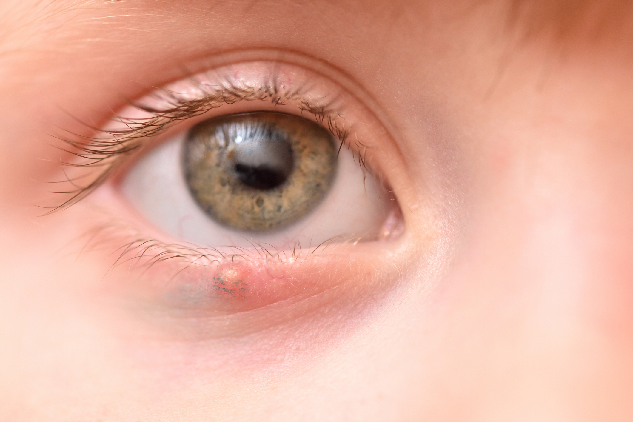 Chalazion Et Enfant Causes Symptomes Et Traitements Parents Fr