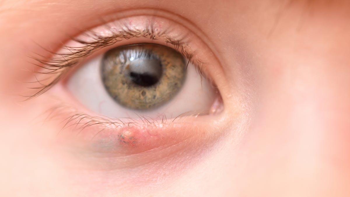 Chalazion Et Enfant Causes Symptomes Et Traitements Parents Fr Chalazion Et Enfant Causes Symptomes Et Traitements Parents Fr