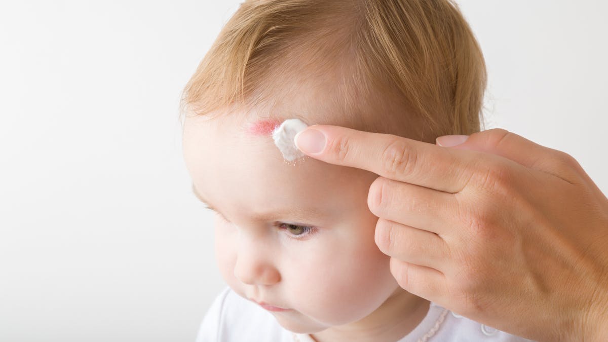 Bleus Et Bosses Que Faire En Cas D Ecchymose Ou D Hematome Chez Bebe Parents Fr Bleus Et Bosses Que Faire En Cas D Ecchymose Ou D Hematome Chez Bebe Parents Fr