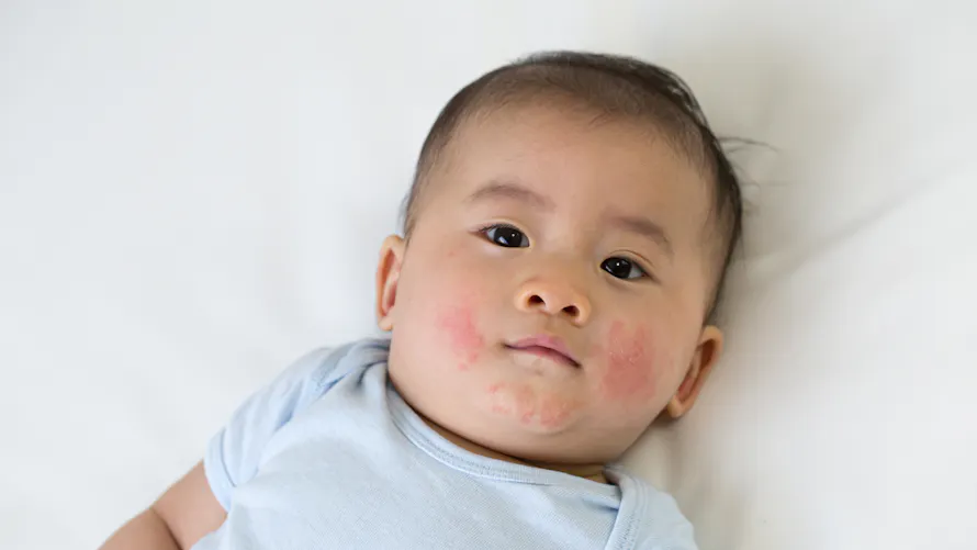 Le mégalérythème épidémique chez l’enfant | Parents.fr