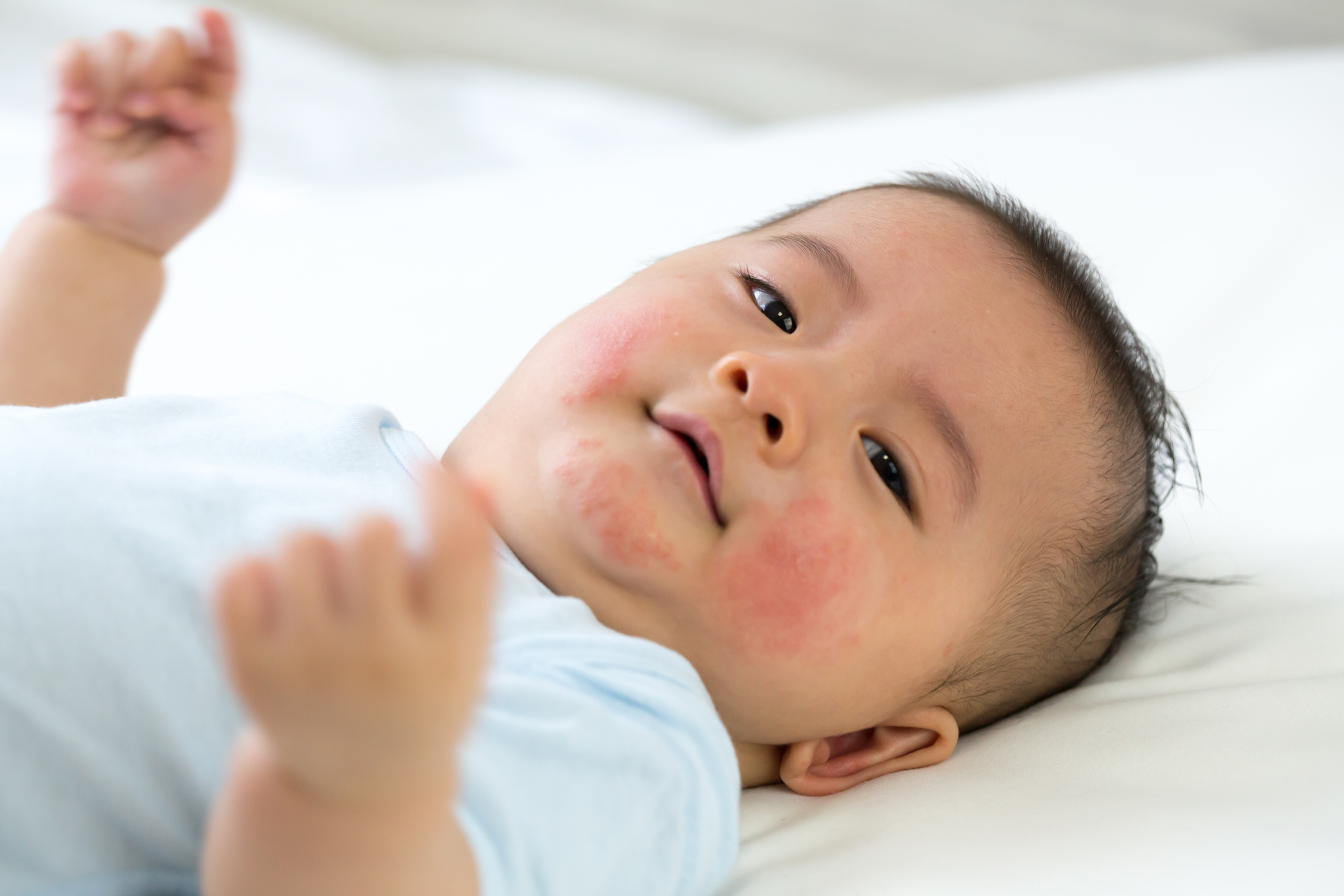Comment soigner les plaques de dartre chez le bébé et le jeune enfant ?
