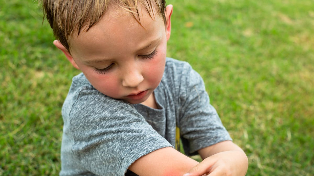 Allergie Aux Piqures De Moustique Causes Symptomes Traitements Parents Fr Allergie Aux Piqures De Moustique Causes Symptomes Traitements Parents Fr