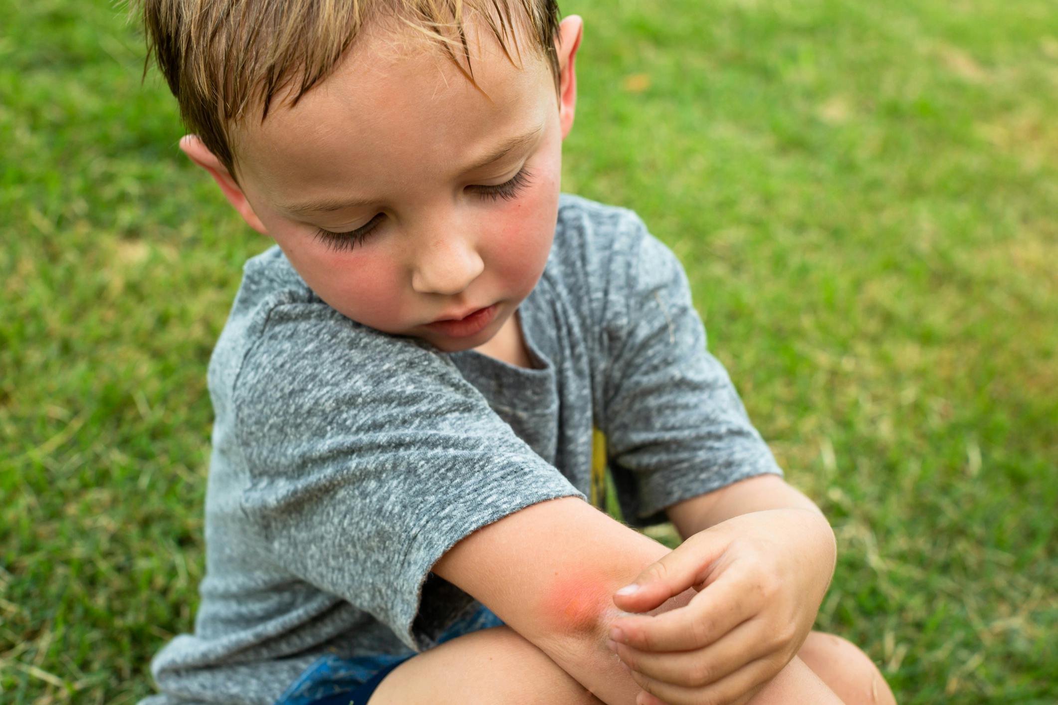 Allergie Aux Piqures De Moustique Causes Symptomes Traitements Parents Fr Allergie Aux Piqures De Moustique Causes Symptomes Traitements Parents Fr