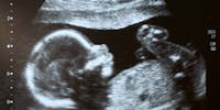 L’échographie obstétricale, trois rendez-vous incontournables au cours de la grossesse