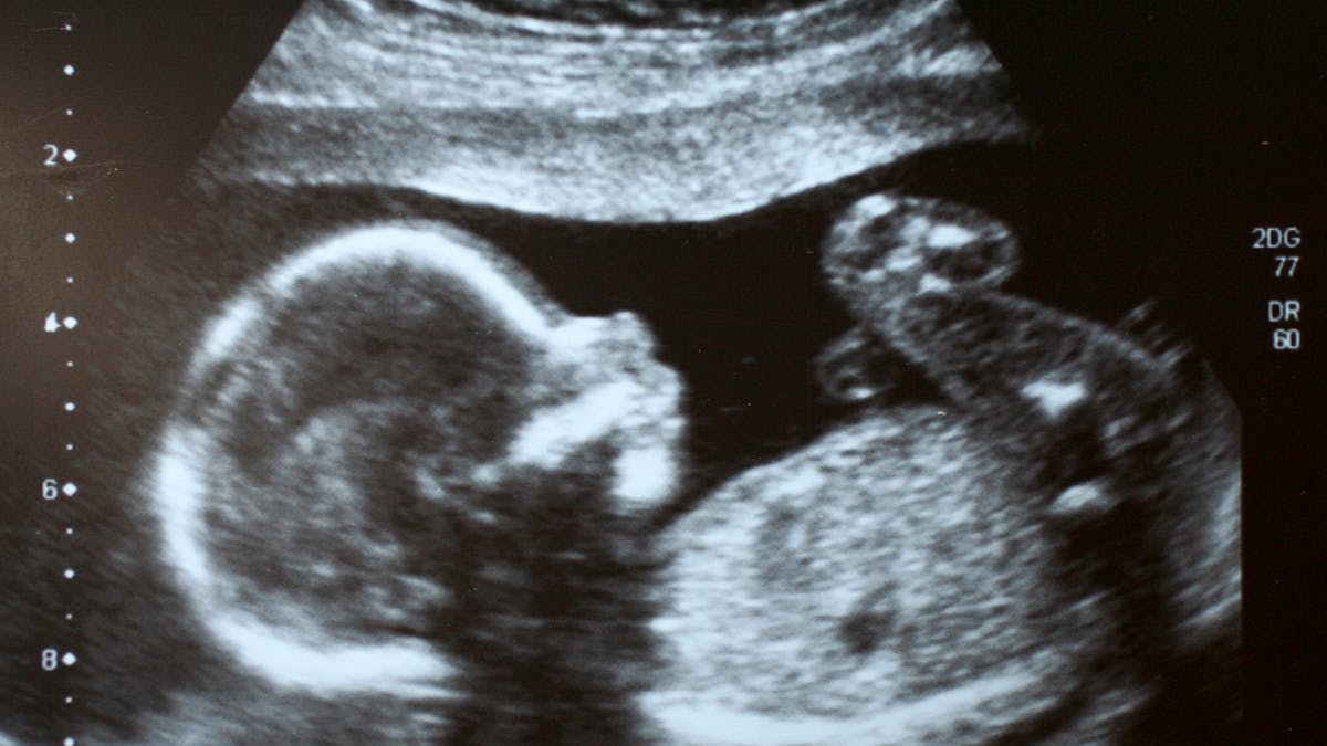 Image du foetus lors d'une échographie obstétricale