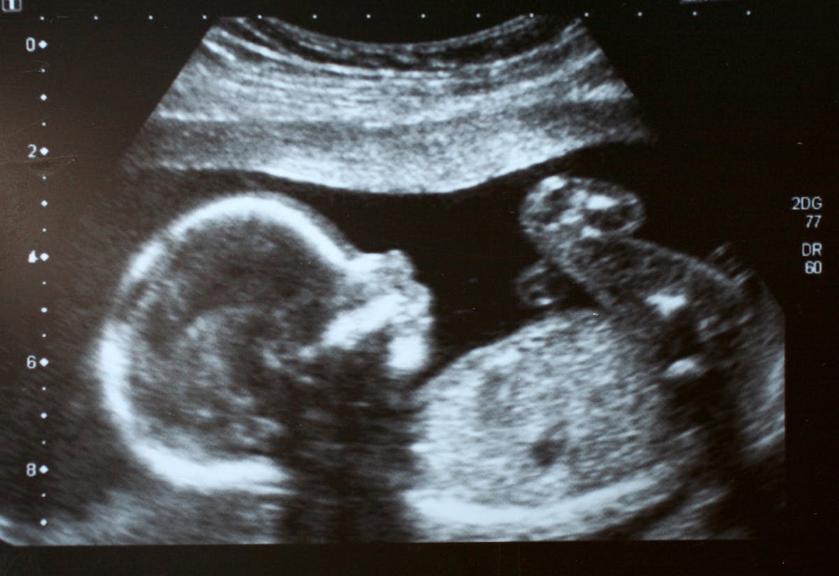 double cadre photo 1er et 2ème échographie bébé