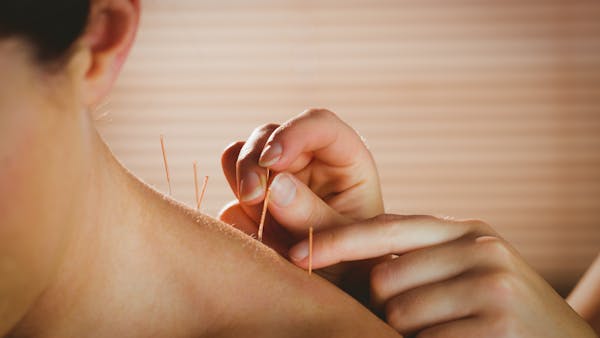 Acupuncture : une sage-femme peut vous aiguiller !
