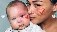 Cette maman fait retirer la tache qui couvre la moitié du visage de son bébé et s'attire les critiques des internautes