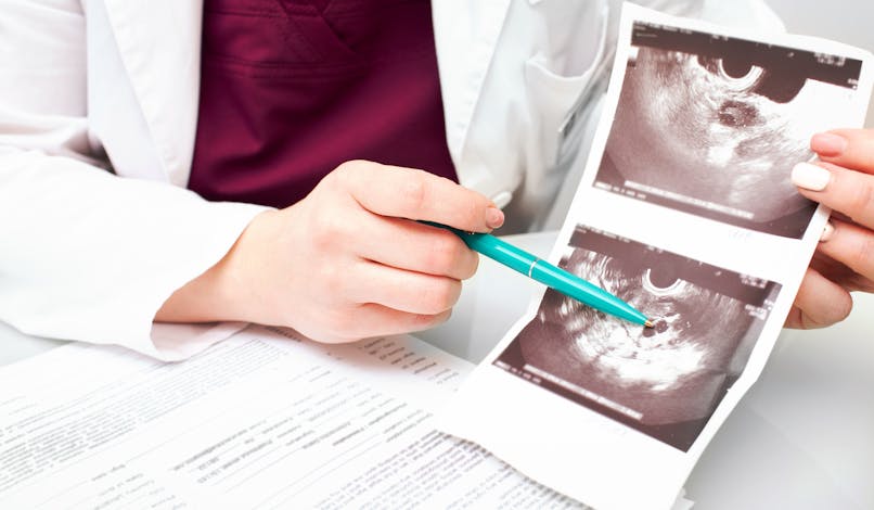 Ovaires multifolliculaires : définition, symptômes et traitement