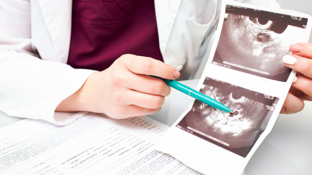Ovaires multifolliculaires : définition, symptômes et traitement