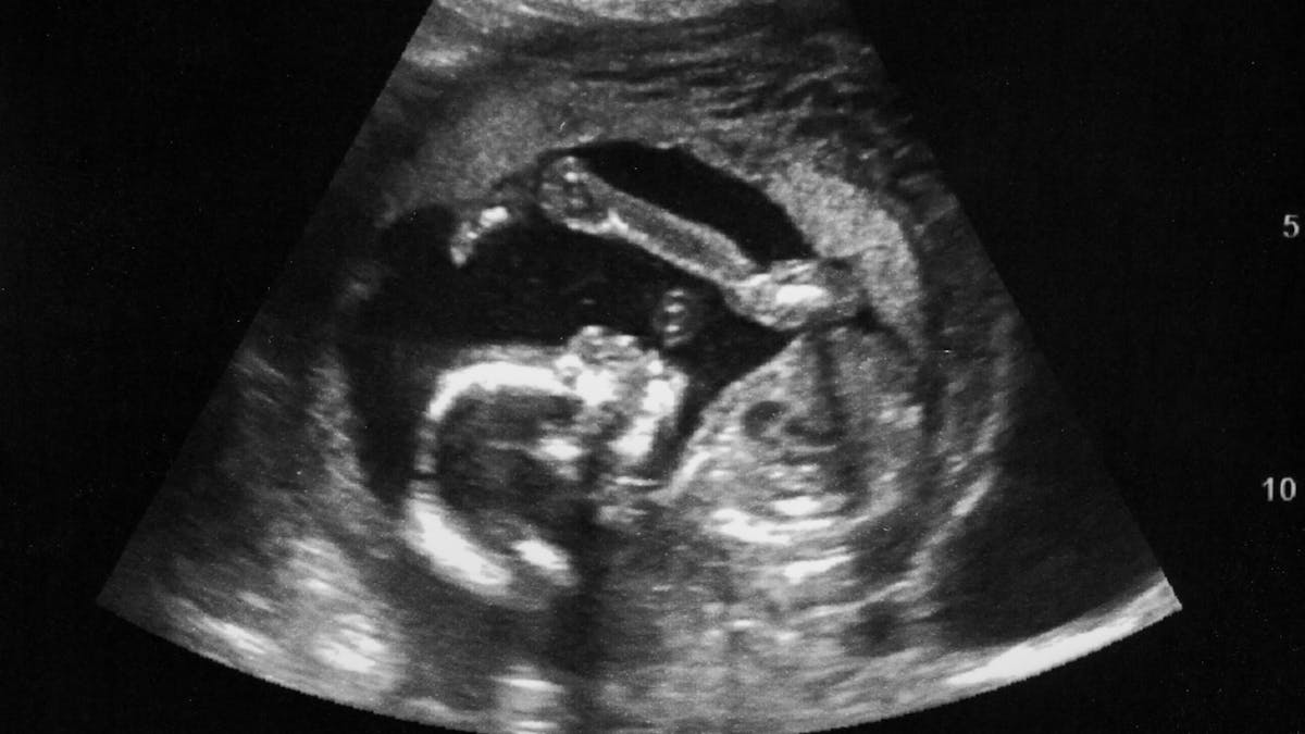 Foetus échographie