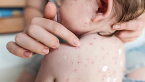 Varicelle, rubéole, rougeole : ces maladies infantiles avec fièvre et éruption cutanée