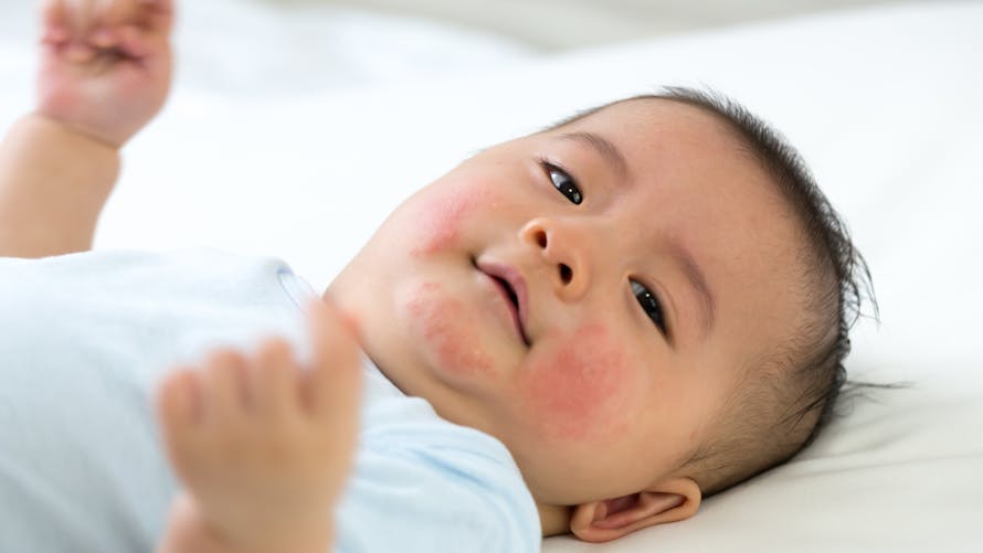 Un bébé a des plaques rouges irritées sur le visage.