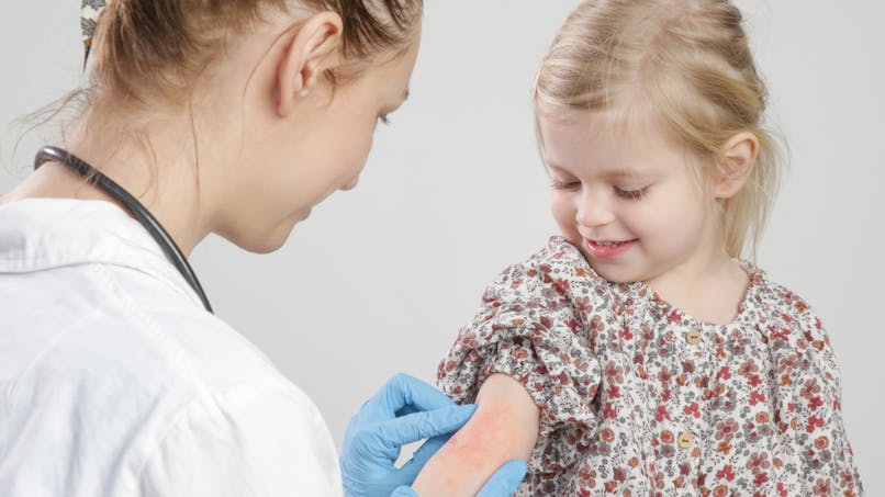 Comment traiter le psoriasis léger chez l'enfant et chez l'adulte ?