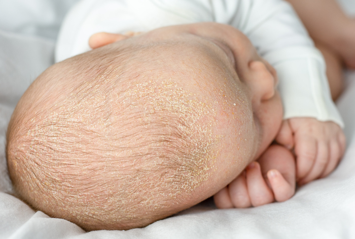 Eczéma sur le cuir chevelu de bébé causes et traitements PARENTS.fr