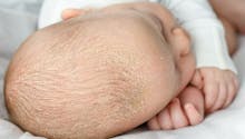 Eczéma sur le cuir chevelu chez le bébé : causes et traitements