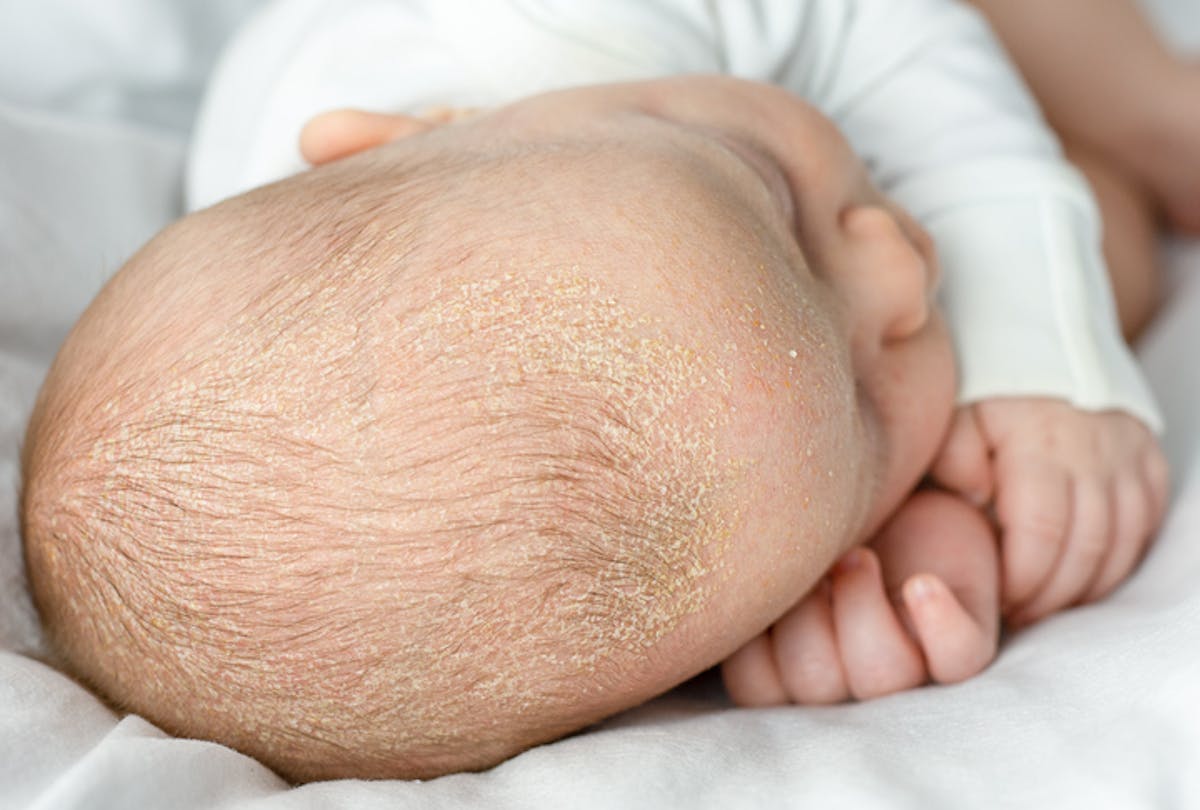 Eczéma sur le cuir chevelu de bébé : causes et traitements ...