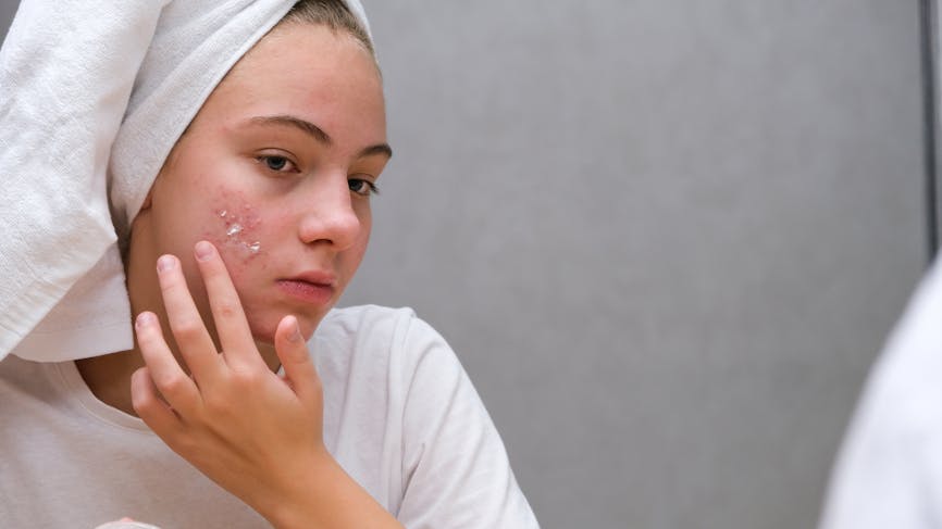 jeune adolescente en train d'appliquer une crème sur ses boutons d'acné