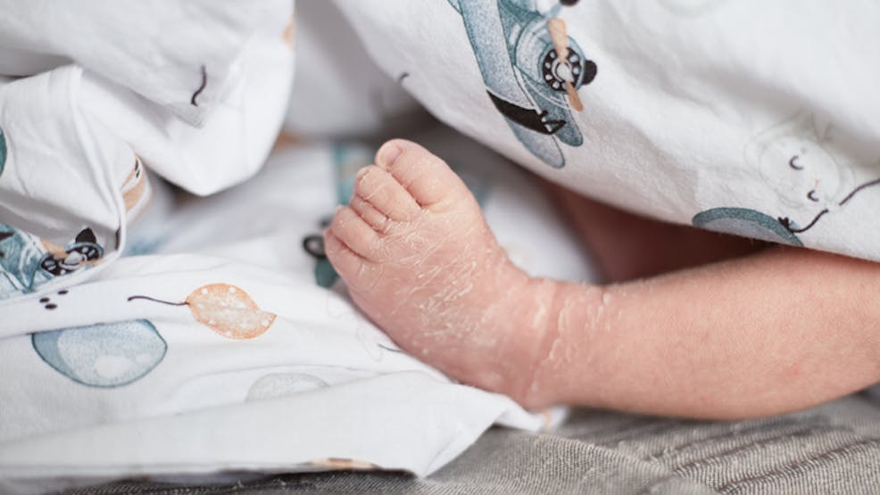 Bébé collodion : définition, causes et traitements | PARENTS.fr