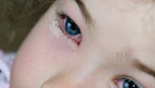 L’œil rose : zoom sur ce nouveau symptôme du Covid lié au variant Arcturus XBB116