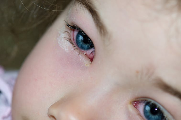 Une petite fille présentant des yeux rougis.