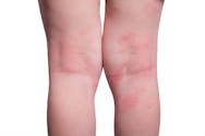 L'eczéma ou la dermatite atopique sur les pieds et les jambes