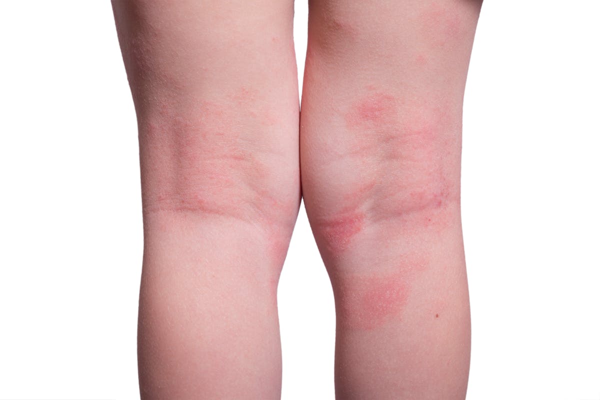 L'eczéma ou la dermatite atopique sur les pieds et les jambes ...