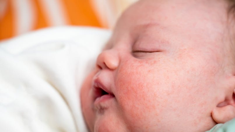 Bébé présentant de l'eczéma sur le visage