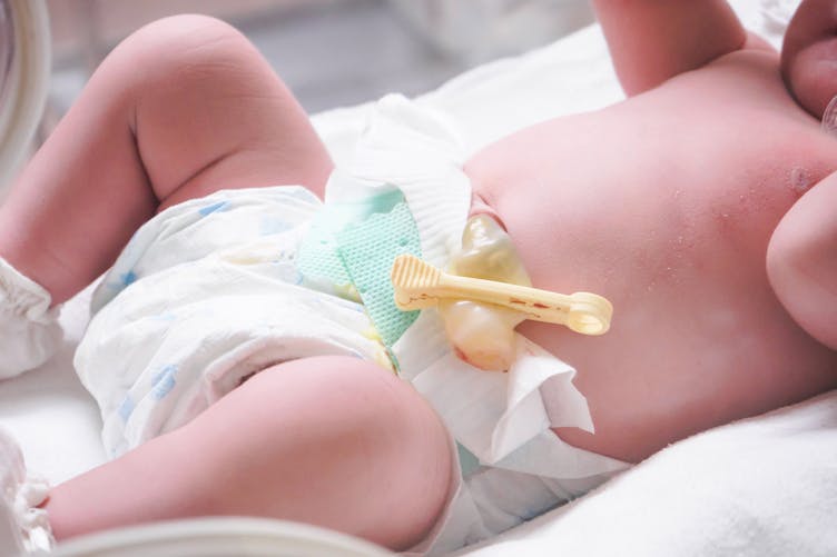 Clamper le cordon des prématurés tardivement serait bénéfique pour les bébés prématurés