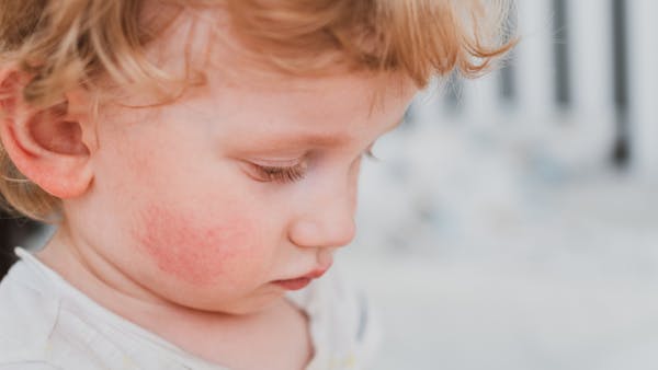 Joues rouges chez l'enfant : ce symptôme à ne pas banaliser, selon les autorités britanniques