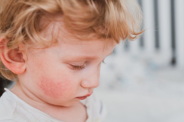 Un jeune enfant présente des joues rougies - syndrome des joues giflées - parvovirus b19