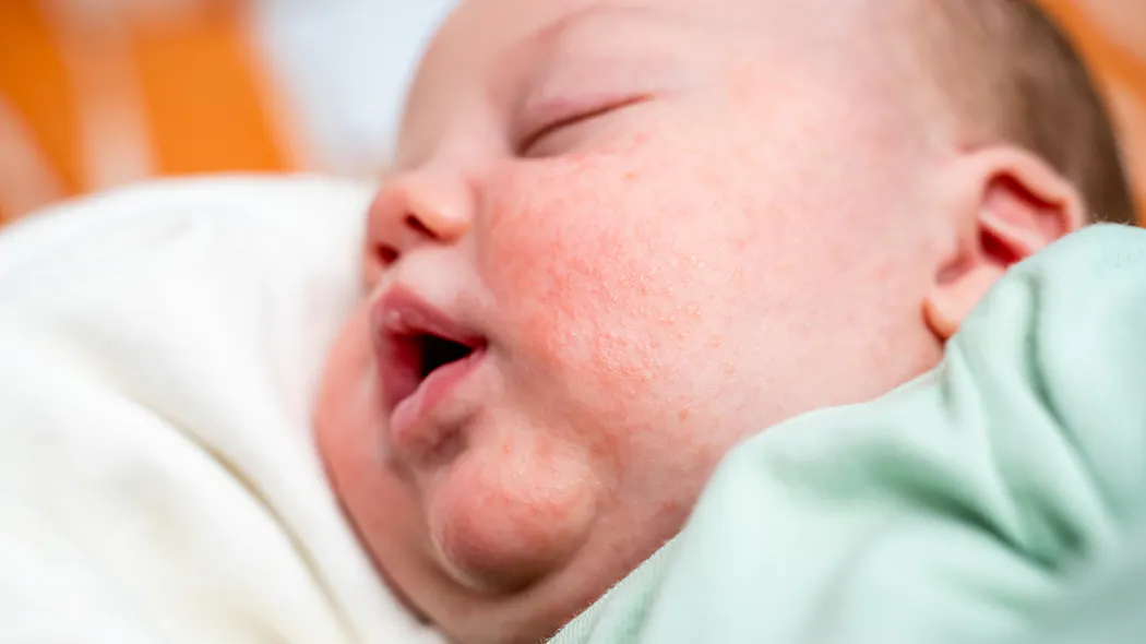 Rouges Head Érythème toxique du nouveau-né : de quoi s’agit-il ? | Parents.fr